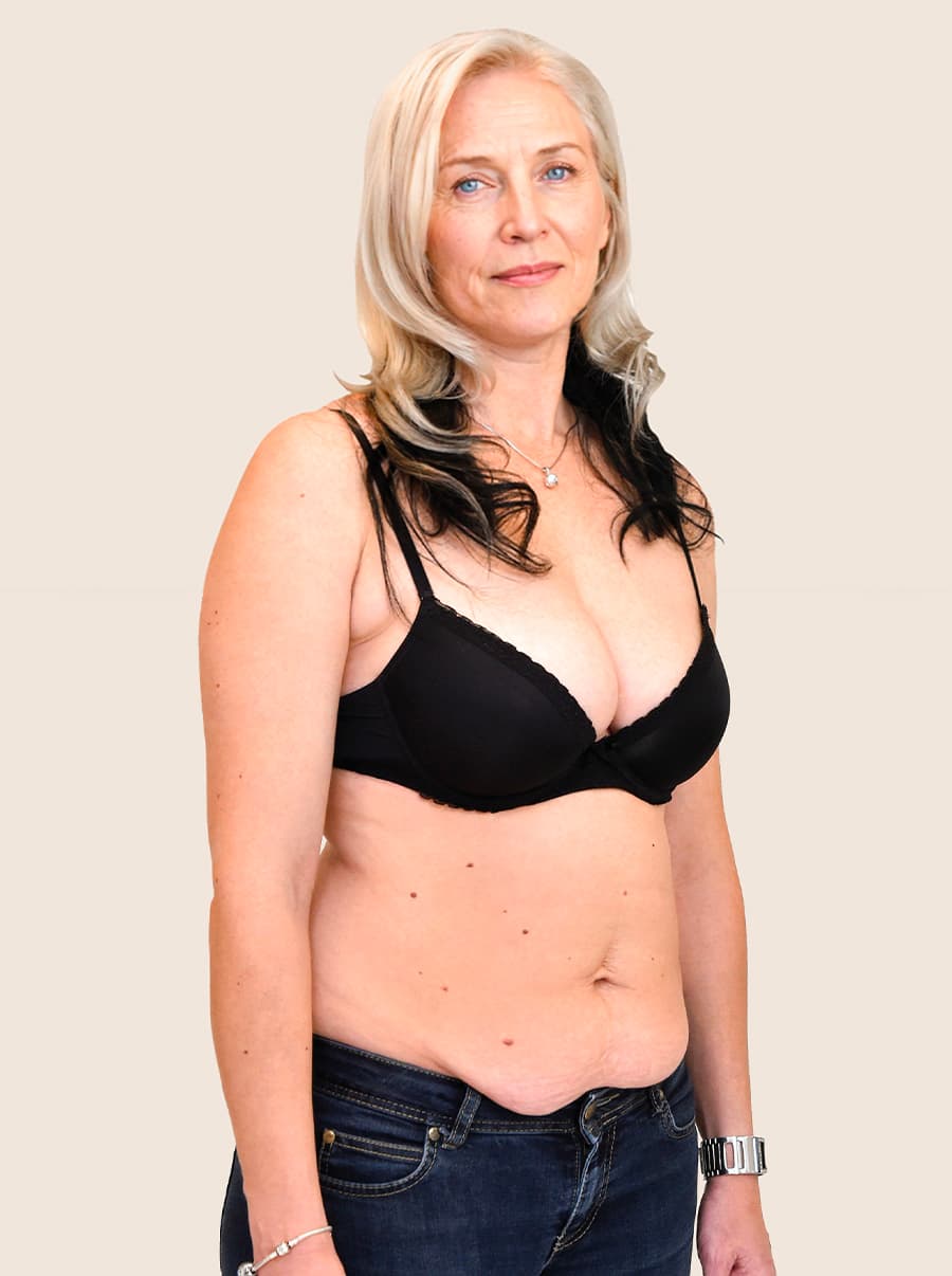 Abdominooplastika před Karolína