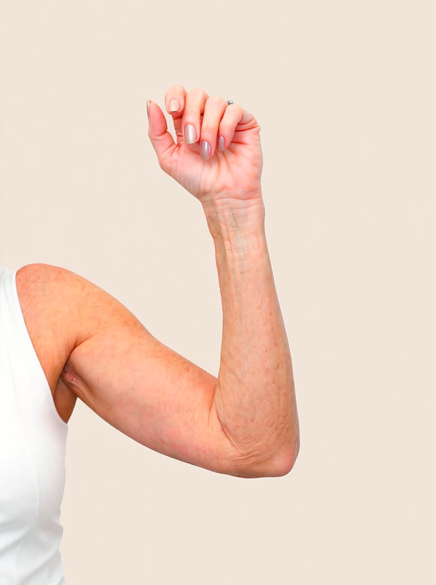 Plastika povolených paží po - vygenerováno generativní umělou inteligencí