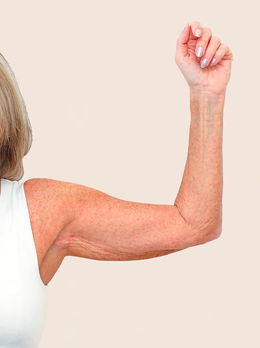 Plastika povolených paží před - vygenerováno generativní umělou inteligencí