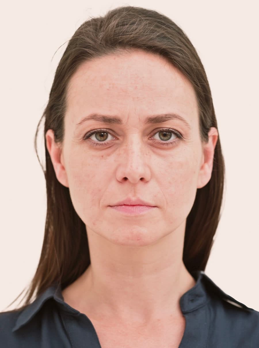 Výplně kyselinou hyaluronovou před - vygenerováno generativní umělou inteligencí